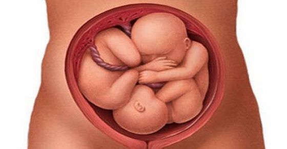 Mang đa thai cũng là 1 nguyên nhân khiến thai chậm phát triển