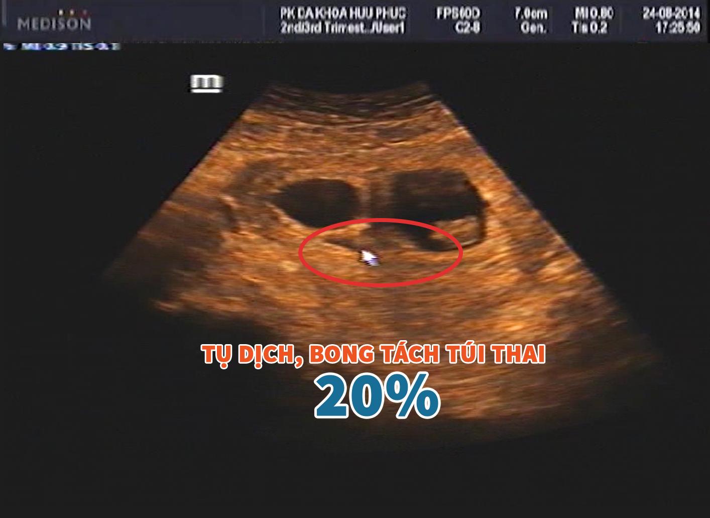Hình ảnh siêu âm bong tách túi thai 20%